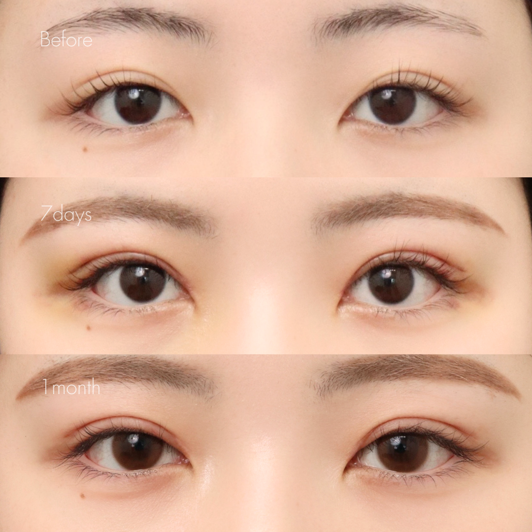 パーフェクト二重術（二重全切開＋たるみ除去＋脂肪除去）＋埋没糸抜去