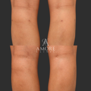 傷跡修正（切開法）