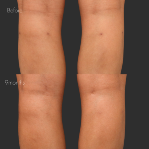 傷跡修正（切開法）