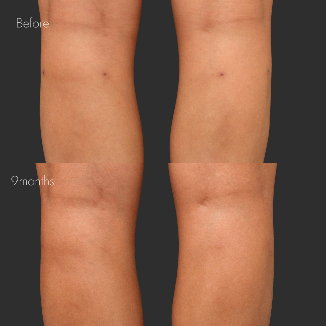 傷跡修正（切開法）