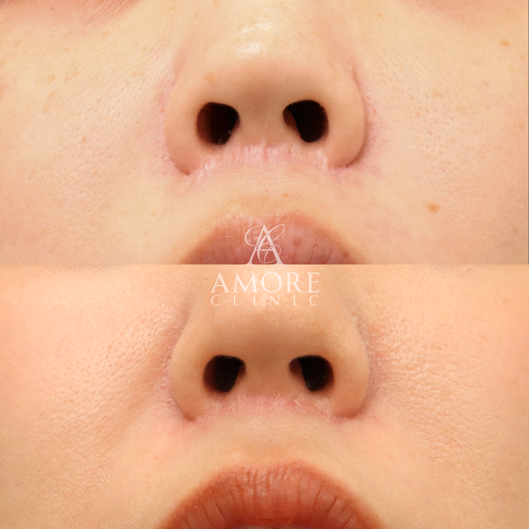 人中短縮後の傷跡修正（グラデーション加工）