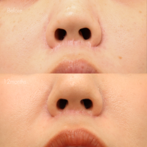 人中短縮後の傷跡修正（グラデーション加工）