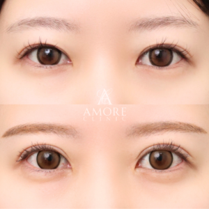 二重全切開（他院修正）＋たるみ除去＋脂肪除去＋癒着解除＋ライン変更＋蒙古襞切除