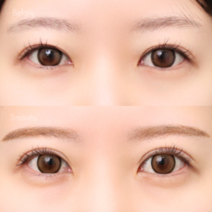 二重全切開（他院修正）＋たるみ除去＋脂肪除去＋癒着解除＋ライン変更＋蒙古襞切除