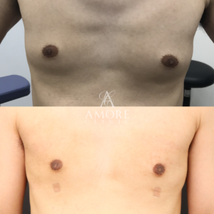 女性化乳房（乳腺・乳房脂肪除去）