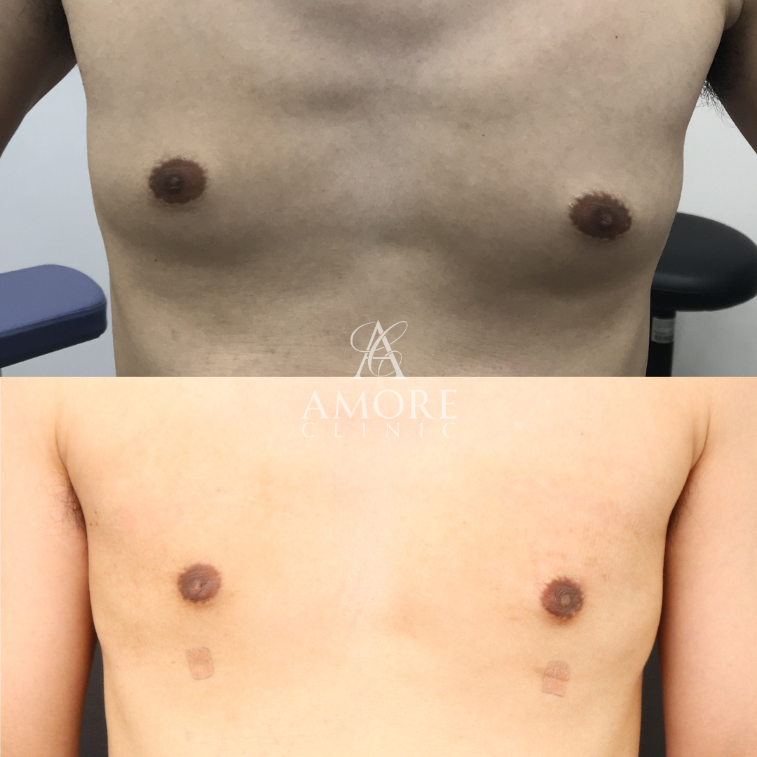 女性化乳房（乳腺・乳房脂肪除去）