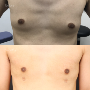 女性化乳房（乳腺・乳房脂肪除去）