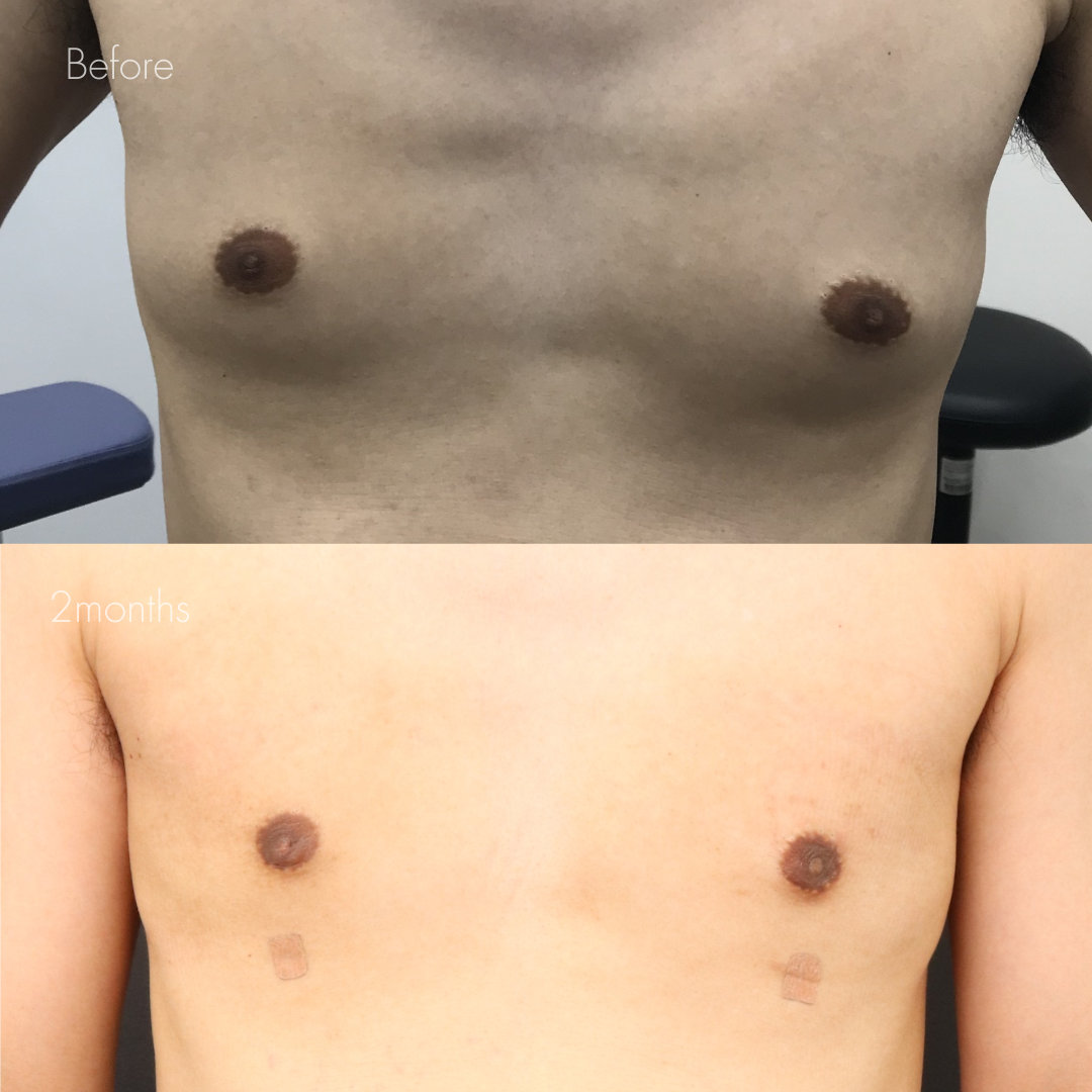 女性化乳房（乳腺・乳房脂肪除去）