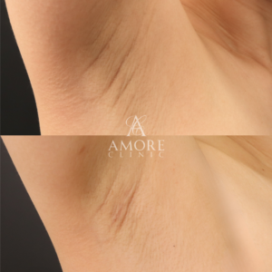 ワキガ治療（剪除法）