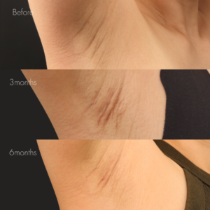 ワキガ治療（剪除法）