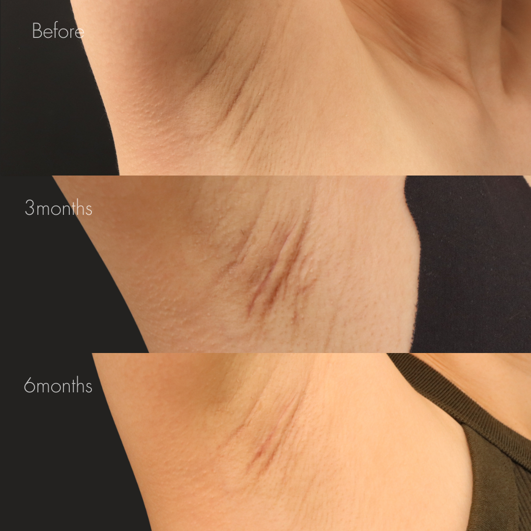 ワキガ治療（剪除法）