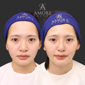 プロテーゼ挿入＋鼻尖縮小＋耳介軟骨移植＋鼻翼縮小＋鼻翼挙上