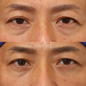 下眼瞼脱脂 （結膜側）＋目の下ヒアルロン酸（ジュビダーム1cc）