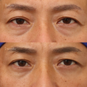 下眼瞼脱脂 （結膜側）＋目の下ヒアルロン酸（ジュビダーム1cc）