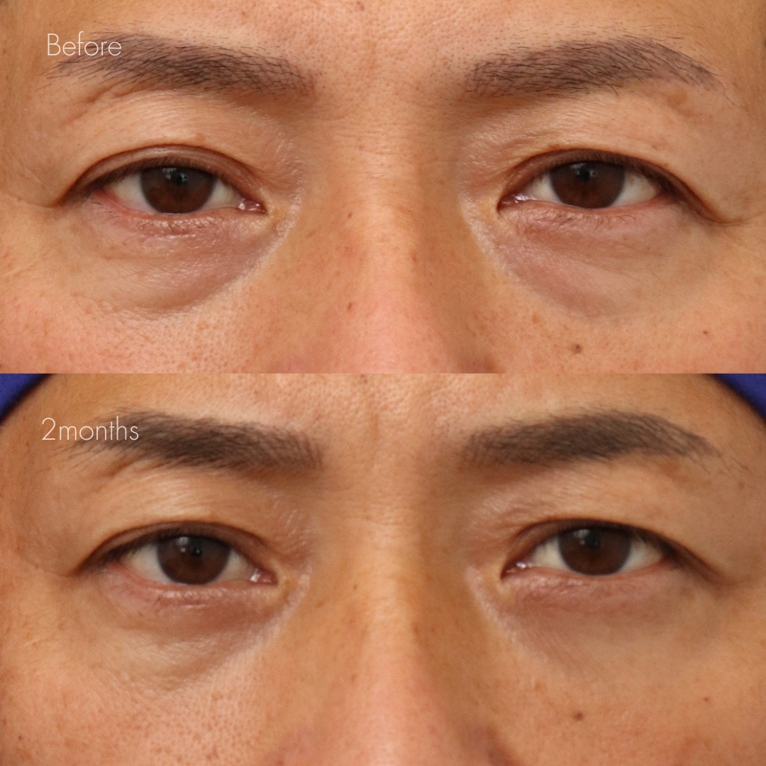 下眼瞼脱脂 （結膜側）＋目の下ヒアルロン酸（ジュビダーム1cc）