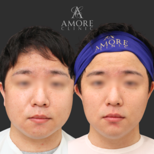 VOVリフト（8本）・あごヒアルロン酸（ジュビダーム1cc）・脂肪溶解注射（あご下・ほほ3V)