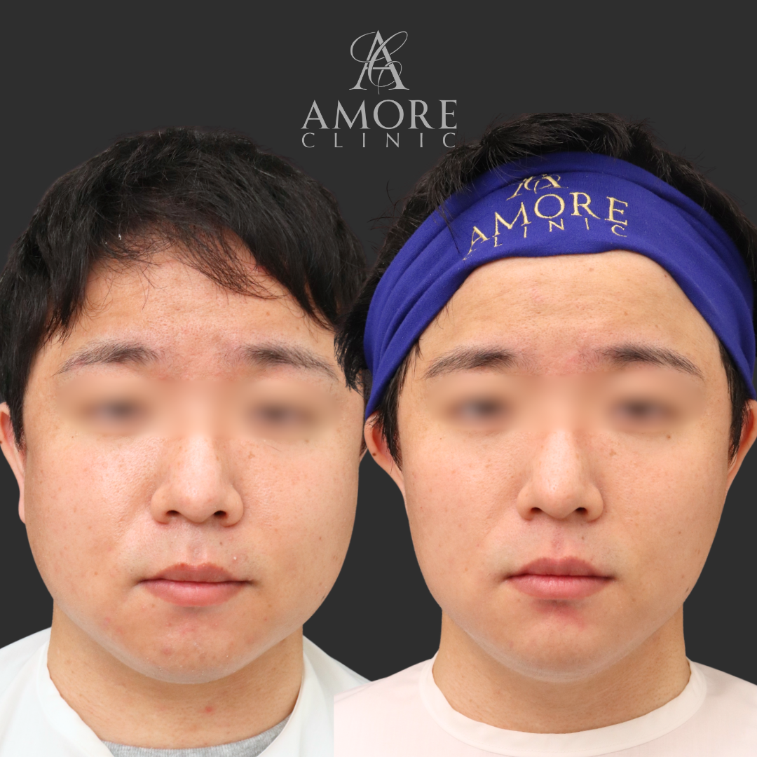 VOVリフト（8本）・あごヒアルロン酸（ジュビダーム1cc）・脂肪溶解注射（あご下・ほほ3V)