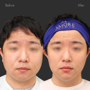 VOVリフト（8本）・あごヒアルロン酸（ジュビダーム1cc）・脂肪溶解注射（あご下・ほほ3V)