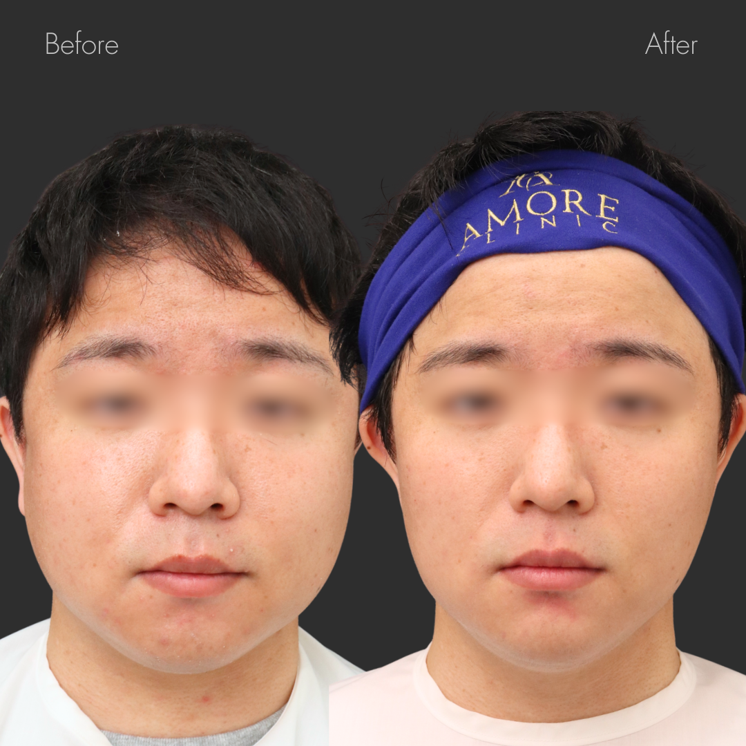 VOVリフト（8本）・あごヒアルロン酸（ジュビダーム1cc）・脂肪溶解注射（あご下・ほほ3V)