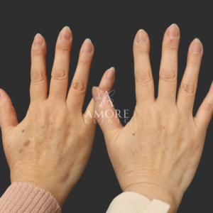 電気分解法＋ピコスポット