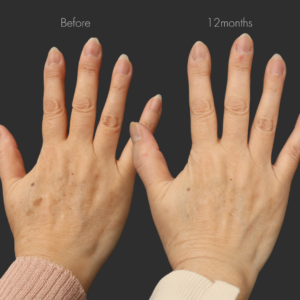 電気分解法＋ピコスポット