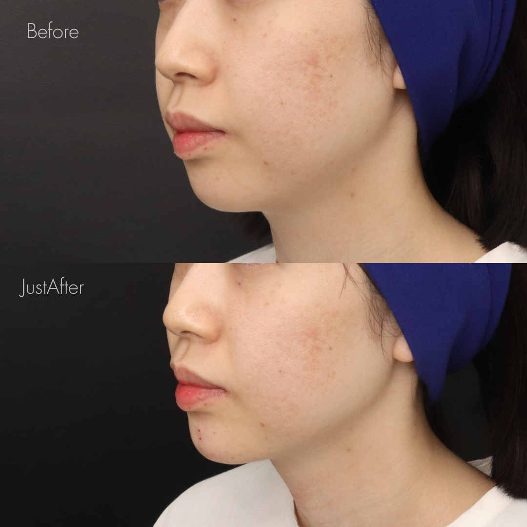 アゴ出しスレッド