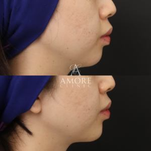 アゴ出しスレッド