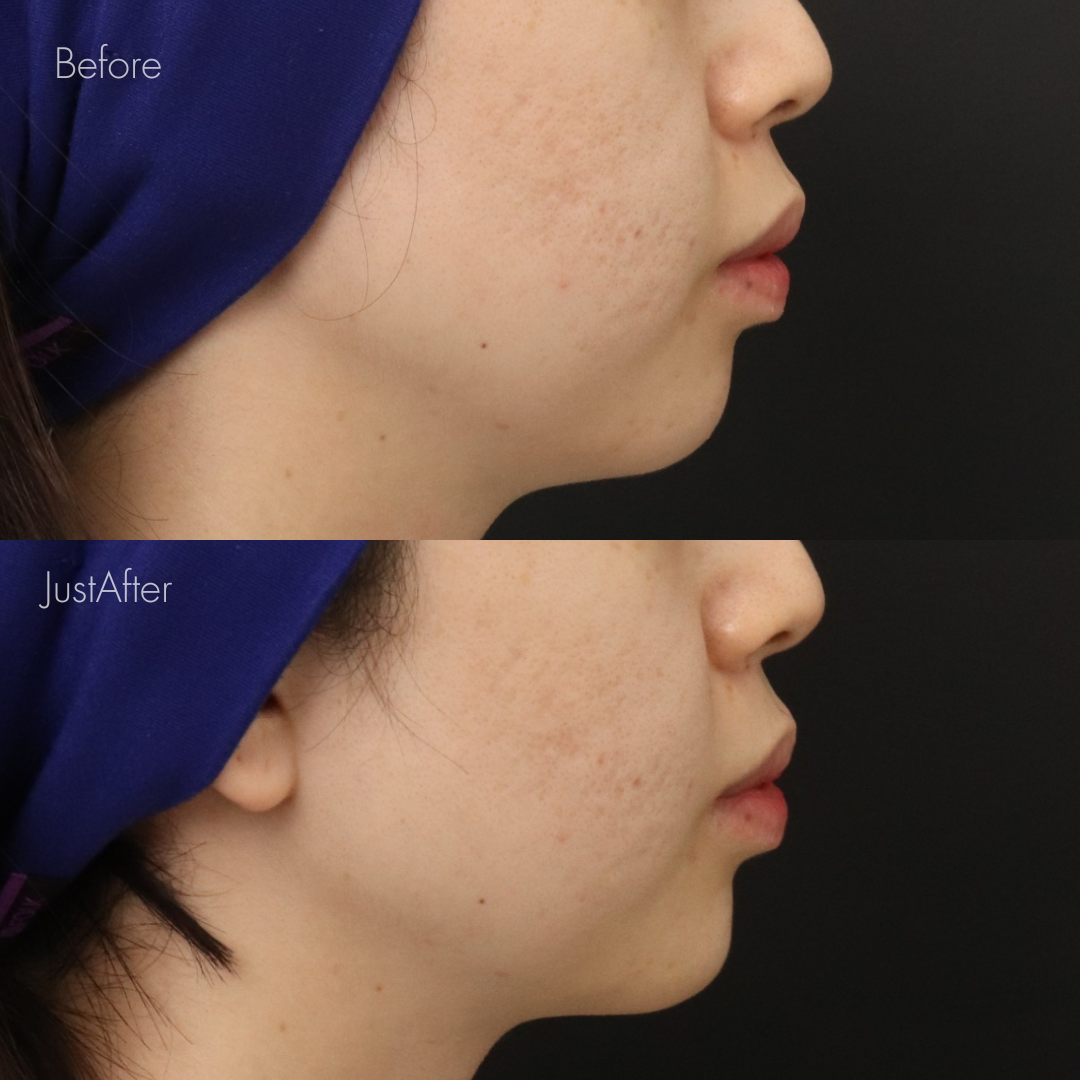 アゴ出しスレッド