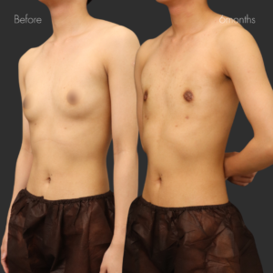  乳腺除去+乳房脂肪除去