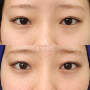 下眼瞼脱脂 （結膜側）