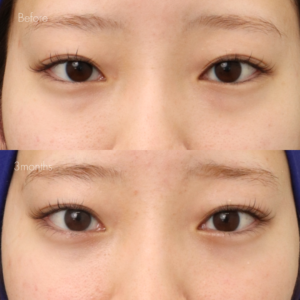 下眼瞼脱脂 （結膜側）