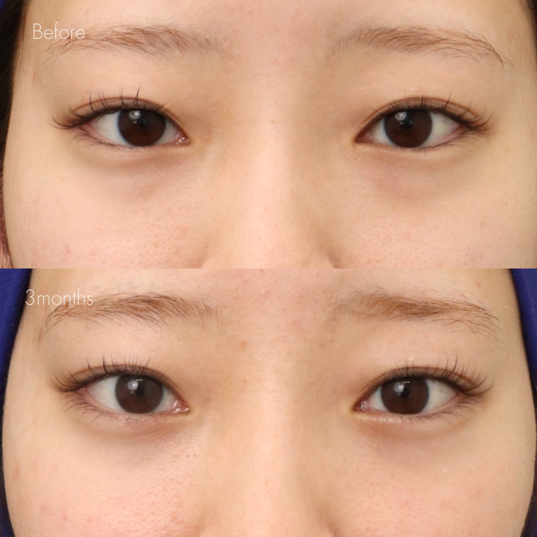 下眼瞼脱脂 （結膜側）