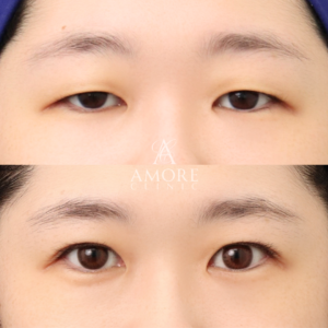 眼瞼下垂+たるみ取り+脂肪取り