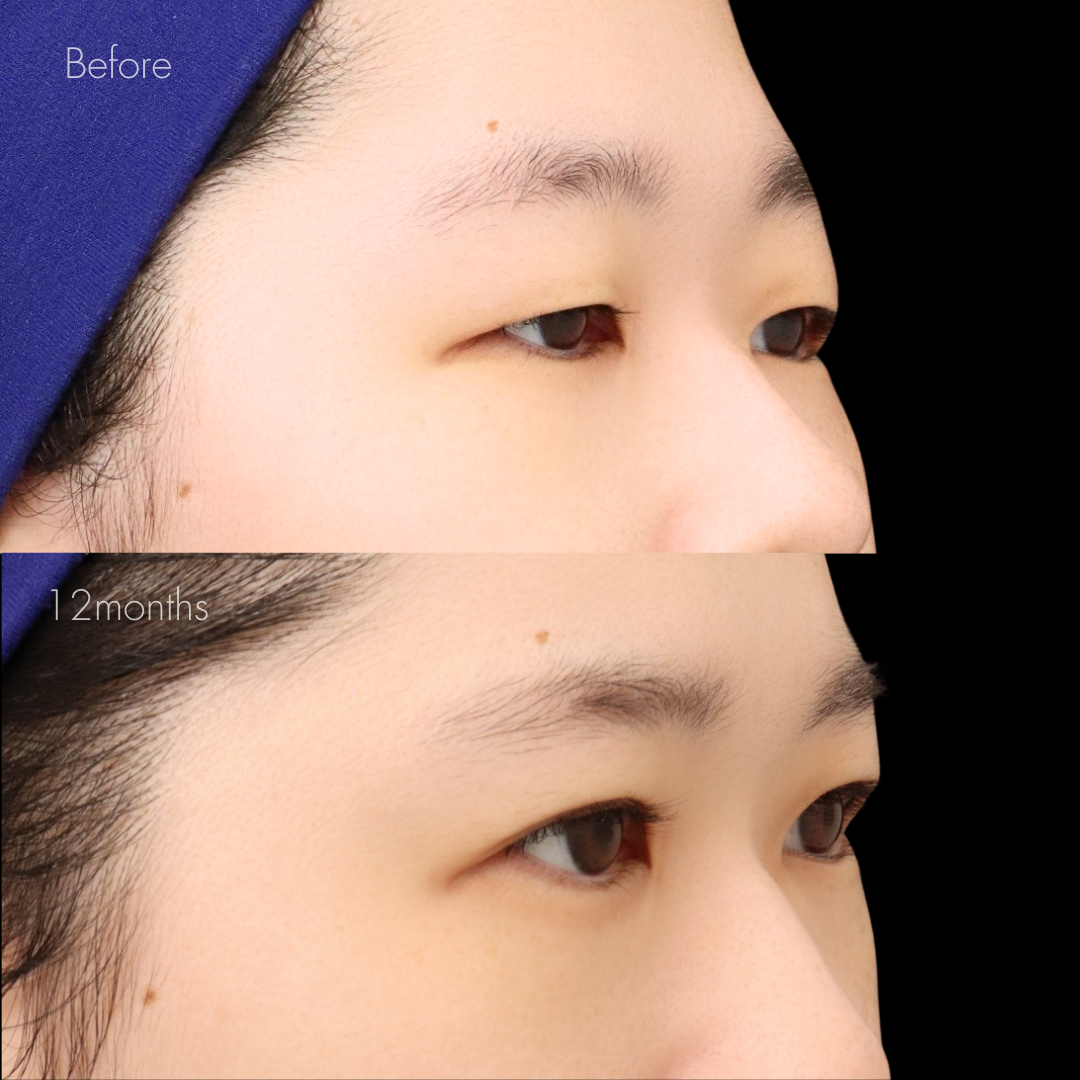 眼瞼下垂+たるみ取り+脂肪取り