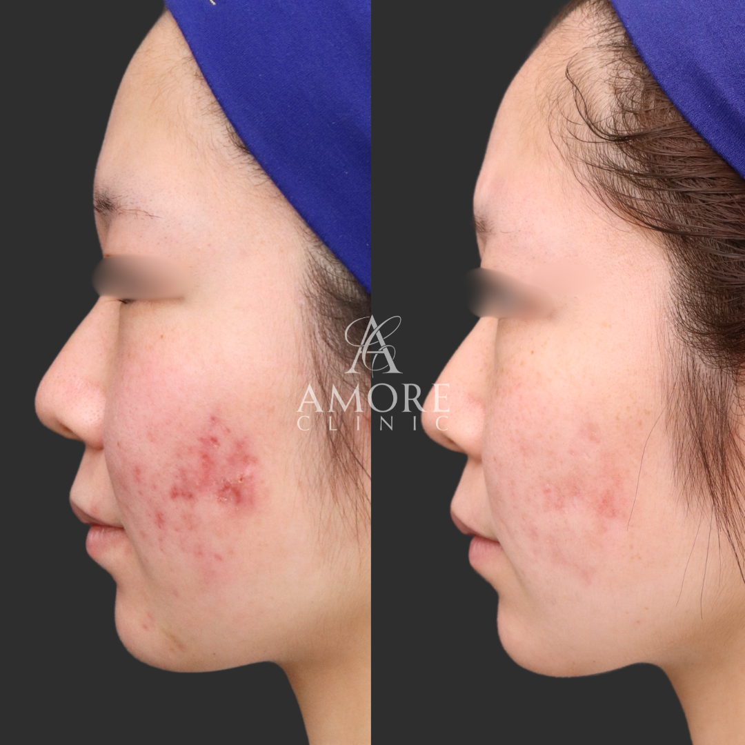 重症ニキビ改善コース