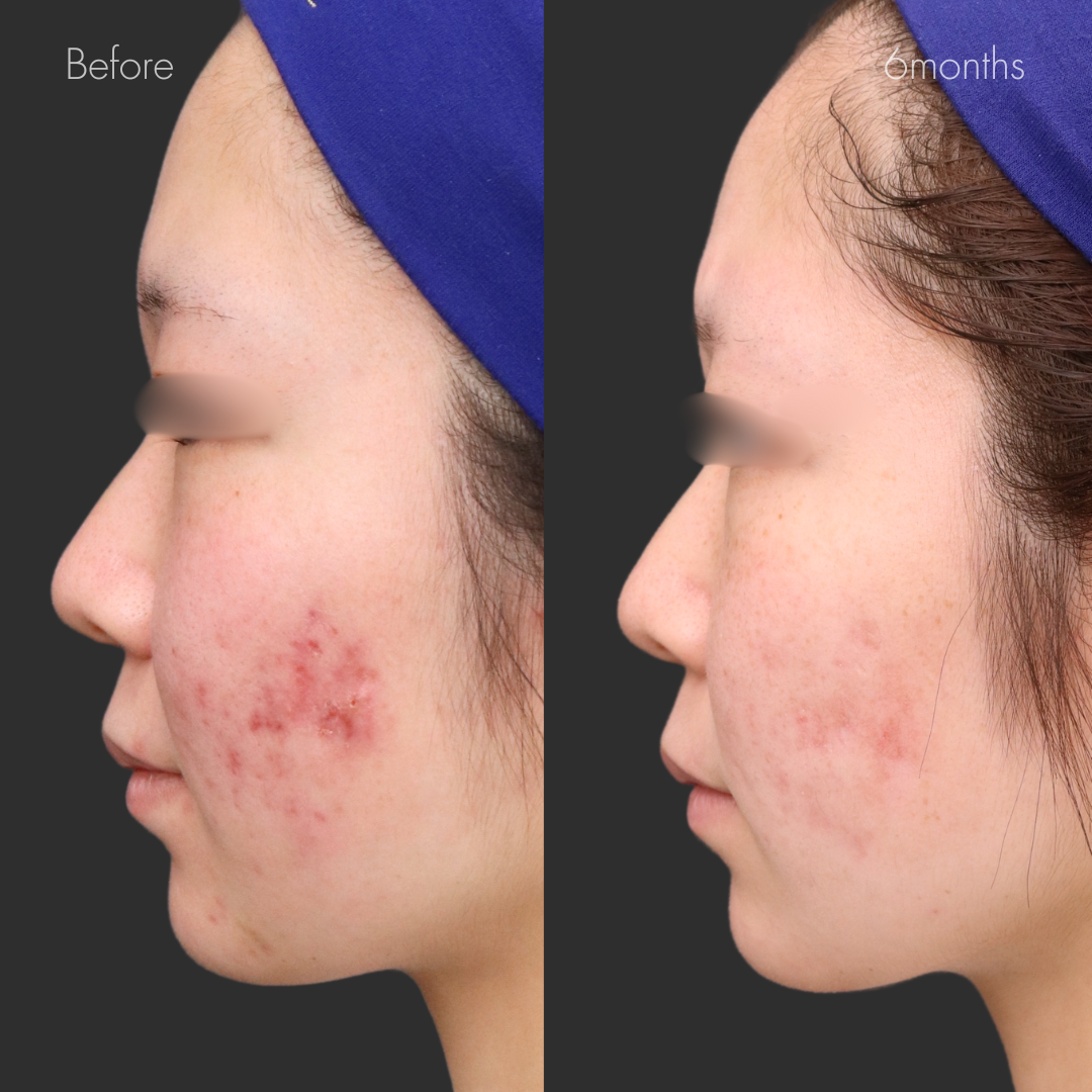 重症ニキビ改善コース