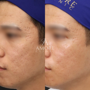 サブシジョン（両ほほ・こめかみ）