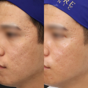 サブシジョン（両ほほ・こめかみ）