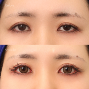 眼瞼下垂(他院修正)＋皮膚除去＋脂肪除去＋癒着解除＋ライン変更