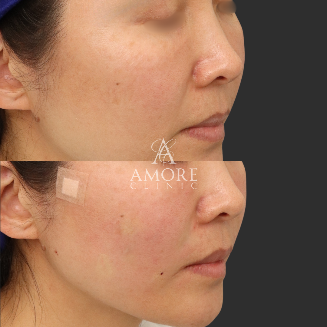 貴族リフト（8本）