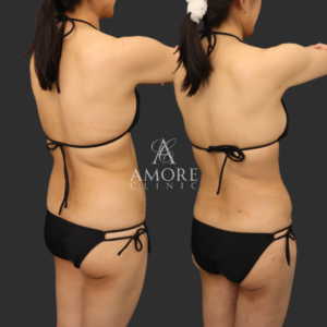 お腹全周・二の腕セット・脇肉・ブラ下脂肪吸引