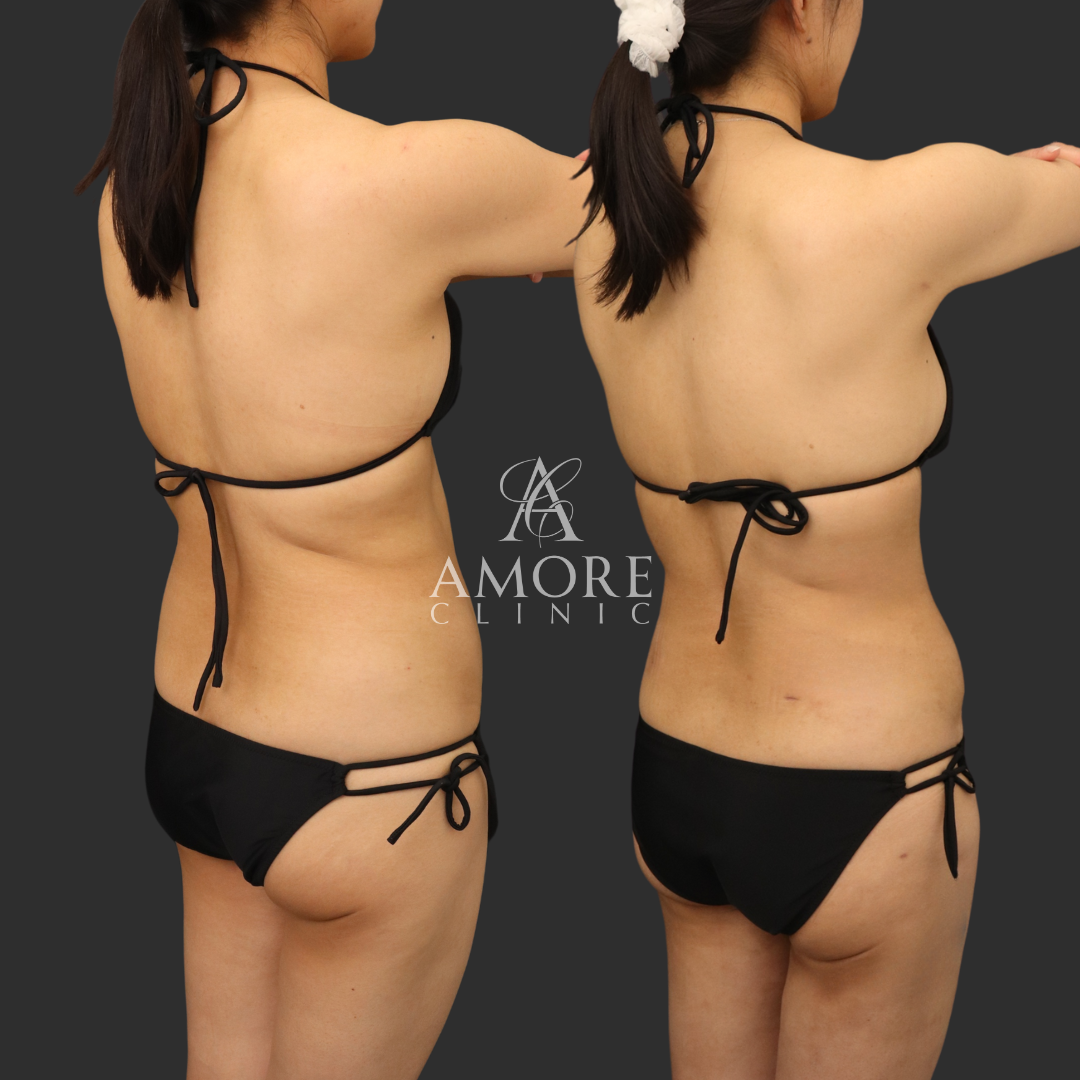 お腹全周・二の腕セット・脇肉・ブラ下脂肪吸引