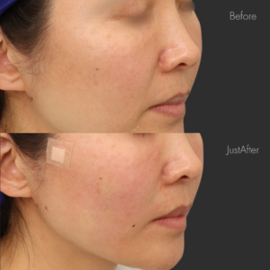 貴族リフト（8本）