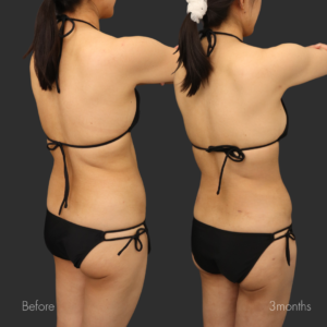 お腹全周・二の腕セット・脇肉・ブラ下脂肪吸引