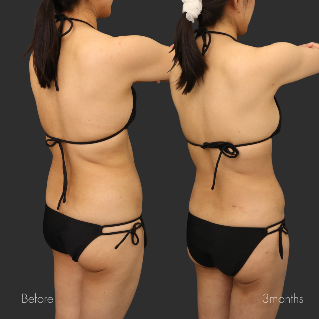 お腹全周・二の腕セット・脇肉・ブラ下脂肪吸引