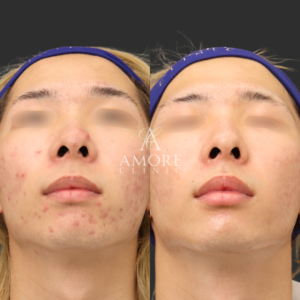 重症ニキビ改善コース＋イソトレチノイン内服