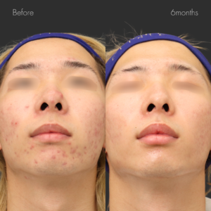 重症ニキビ改善コース＋イソトレチノイン内服