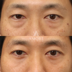 下眼瞼脱脂 （結膜側）