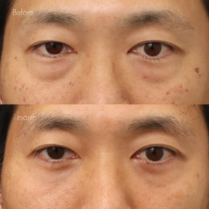 下眼瞼脱脂 （結膜側）