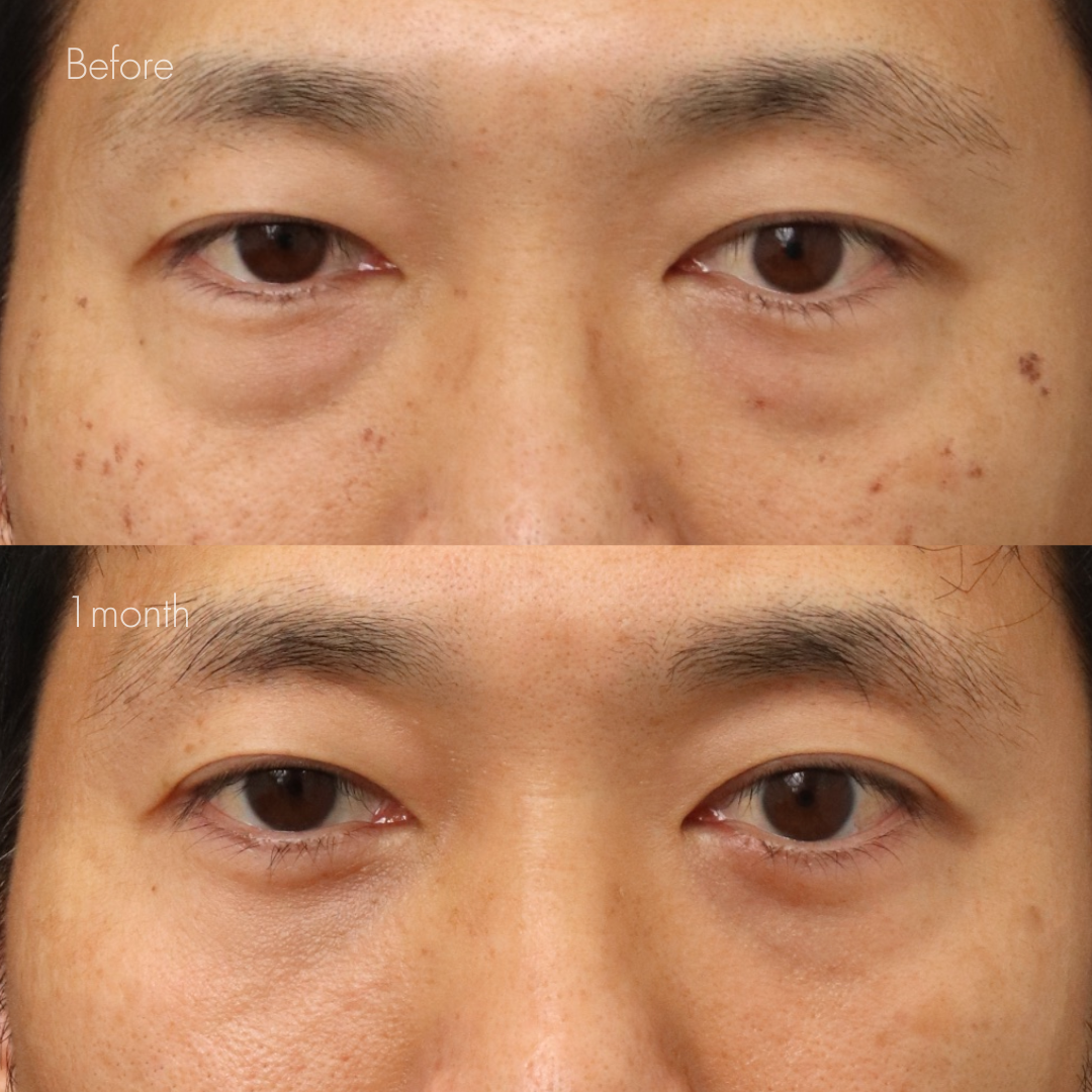 下眼瞼脱脂 （結膜側）